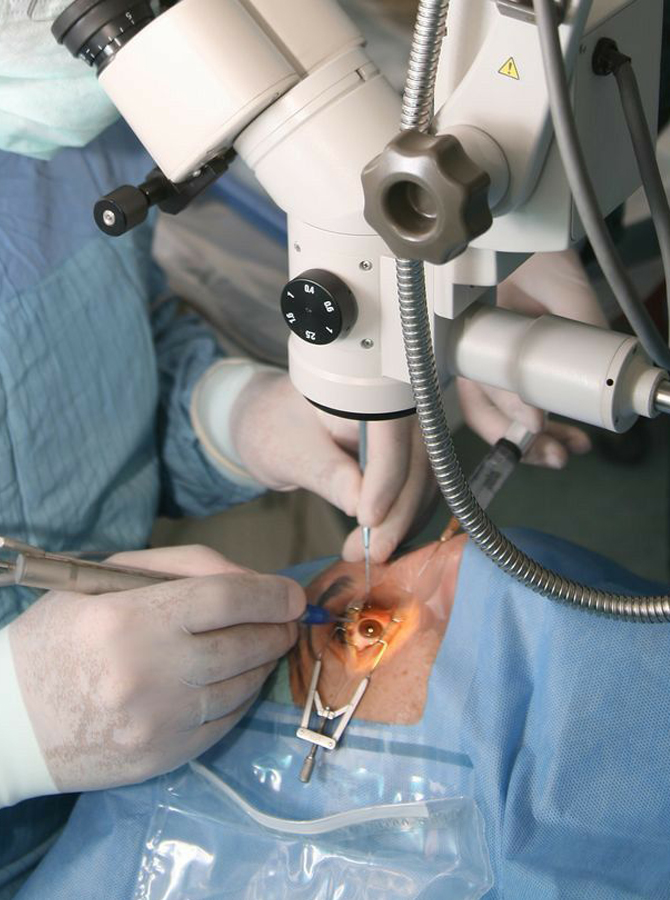 Cataract Surgery