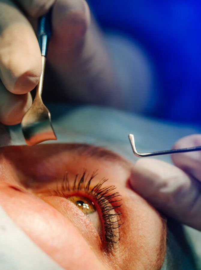 Cornea Transplant