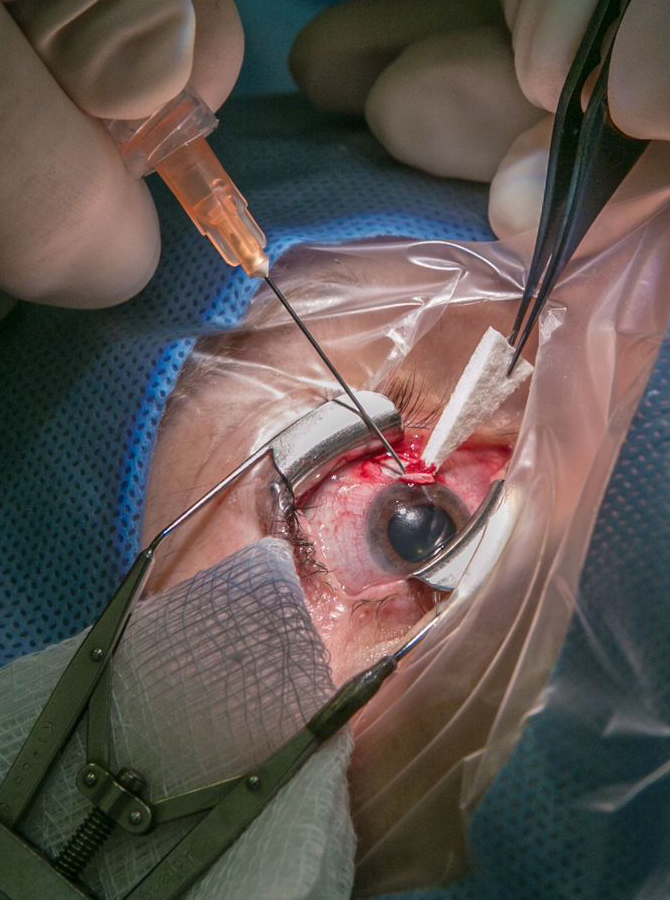 Glaucoma Surgery